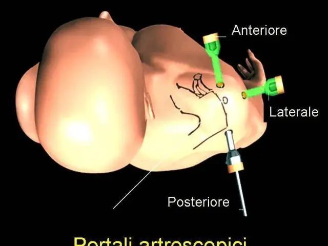 Riparazione artroscopica della cuffia dei rotatori