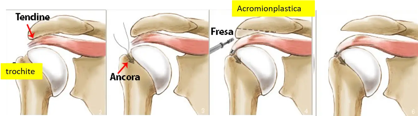 Riparazione artroscopica cuffia rotatori